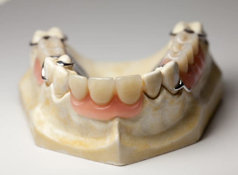 What Is Cast Partial Denture? GlobalDentalPro